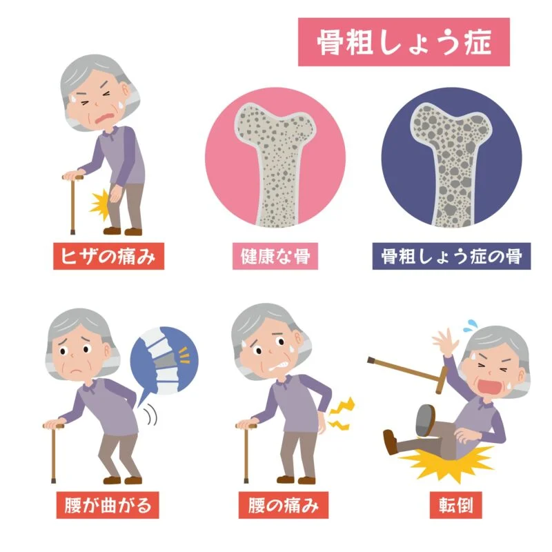 骨粗鬆症（こつそしょうしょう）