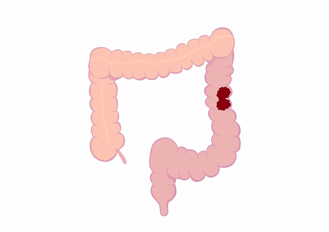大腸がんとは