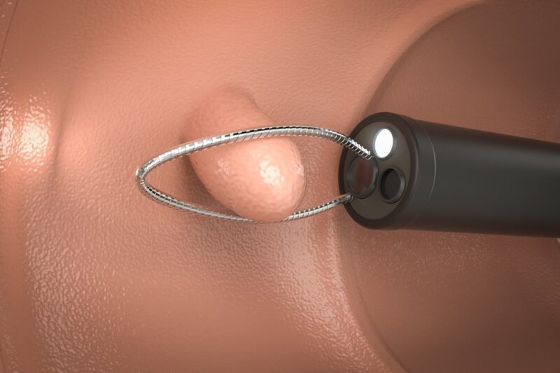 検査中の大腸ポリープ切除に対応