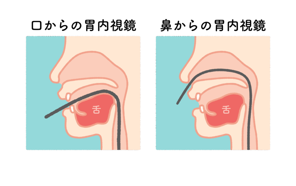 経口内視鏡検査と経鼻内視鏡検査どちらも選択可能
